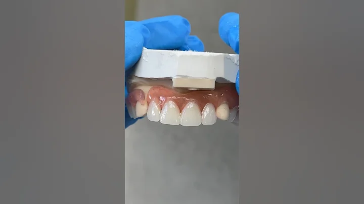 Clasping to Canines @EnvisiontecMain #envisiontec #dental #teeth #smile #lsk121shorts #shortvideo