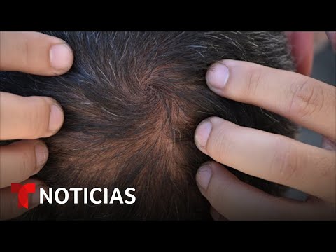 Video: ¿Vedix tiene efectos secundarios?