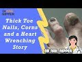 Thick Toenails, Foot Corns (Calluses) and Heart Wrenching Story