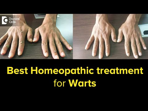 Best Homeopathic Treatment of Warts | Before &  After Treatment-Dr.V.Bhagyalakshmi | Doctors&rsquo; Circle