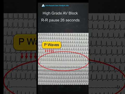 LBBB syncope. Think....