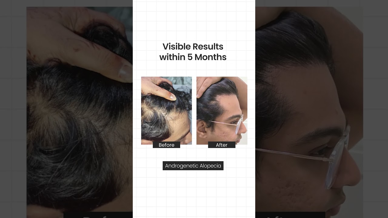 Dr Batra’s® Male Pattern Baldness Treatment | Androgenetic Alopecia Results #shorts #review