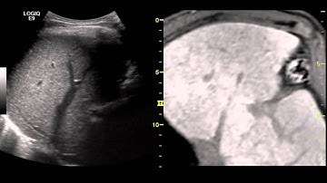 Fusion imaging of real-time ultrasonography with CT or MRI for hepatic intervention