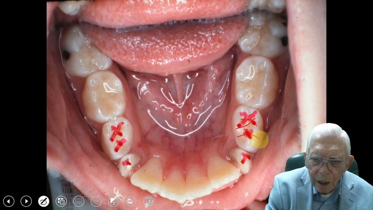 Natures Guidance in Orthodontics - Serial Extractions Unveiled