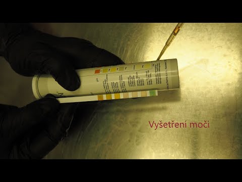 Video: Sediment V Moči: Bílý, Amorfní, Viditelný, Hnědý A Katetr