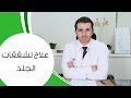 علاج تشققات الجلد I مع الدكتور