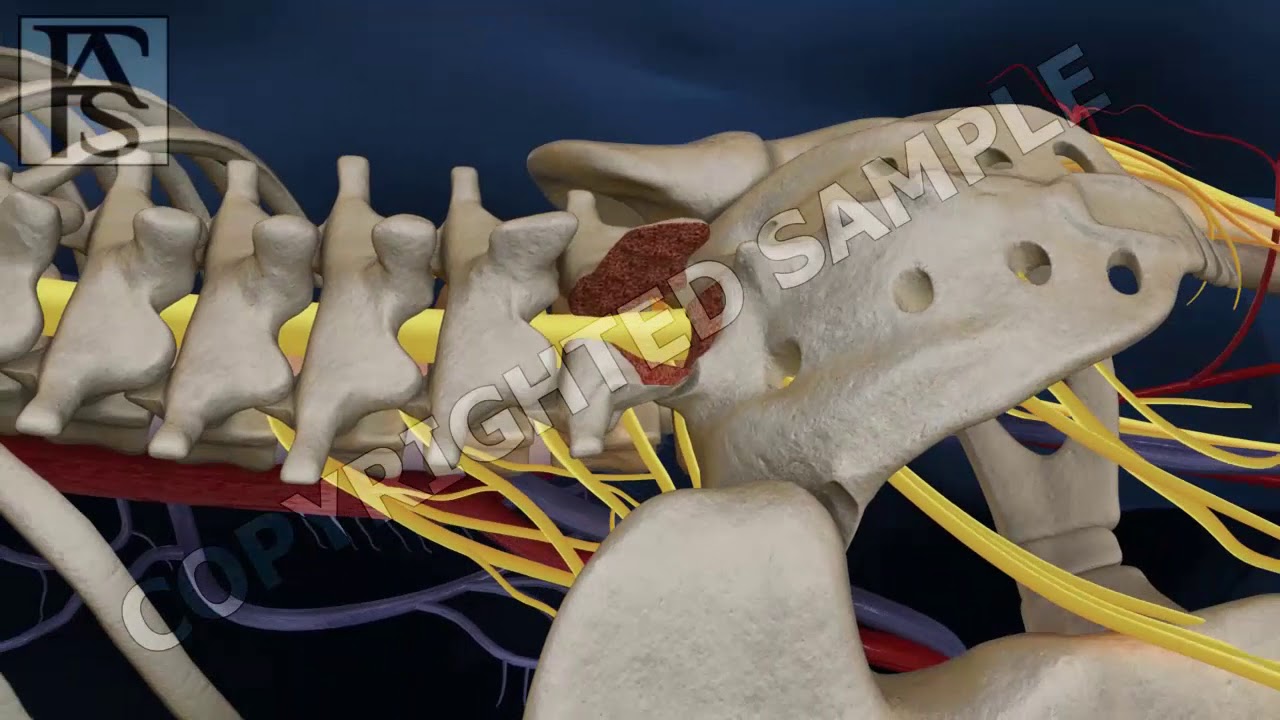 Back Surgery Fusion Animation