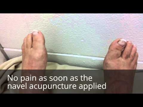 Navel Acupuncture treatment for joints pain, Acid Reflux, Neck pain 