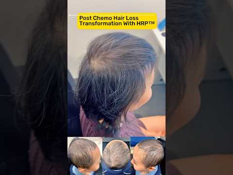 12-month hair loss transformation with HRP™️ after chemo #HRP™️ #hairlosstreatment #DrHopkirk #hair