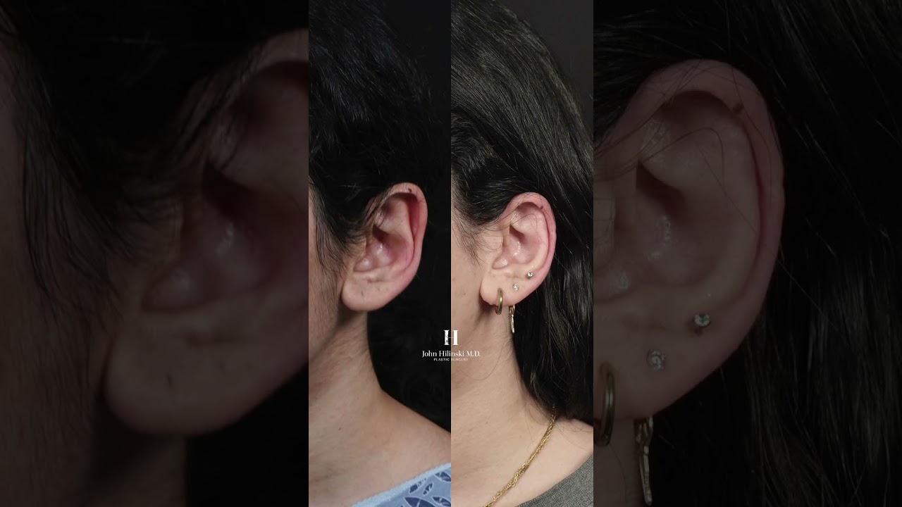 Natural Ear Reduction Surgery