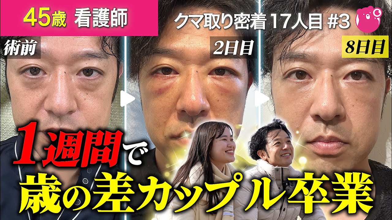 目の下のクマ取り整形「モフィウス8＋裏ハムラ」のダウンタイム1ヶ月に密着！術前との衝撃変化も大公開！#ダウンタイム #目の下のたるみ取り #美容整形 #湘南美容クリニック #裏ハムラ #モフィウス8