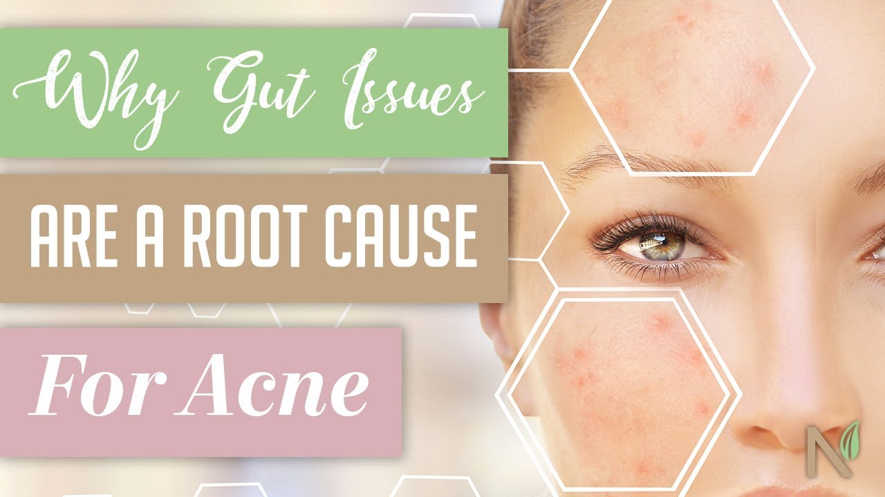 Root Cause For Acne - YouTube