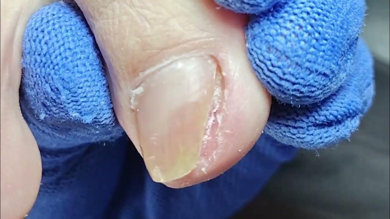Foot care trimming of yellowing hard toenails YouTube