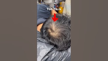 Khủng hoảng, trầm cảm, ám ảnh vì tóc thưa #xămtóc #scalp #hói_đầu #hói #smptraining