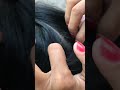 #fypviralシ #statisfying #Lice #hair #LiceOnHead #liceremoval #brasil #xyzbcafyp #licepopping #kutu