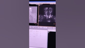 brachial plexus ||Mri||Full video soon||