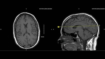 Unremarkable Non-Contrast Brain MRI: Axial T1- Example 1