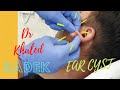 Massive 15 yr Ear Cyst. Dr Khaled Sadek. Lipomacyst.com