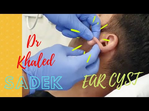 كيس أذن ضخم عمره ١٥ عام ا د خالد صادق Lipomacyst Com