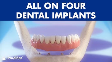 All on 4 dental implant treatment - Fixed denture ©