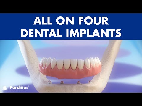 All on 4 dental implant treatment - Fixed denture ©