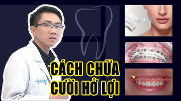 Cười Hở Lợi Nên Niềng Răng Hay Phẫu Thuật? Phương Pháp Điều Trị Đơn Giản Từ Vinalign