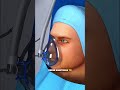 This Is How Haglund’s Deformity Is Fixed (3D Animation) #medicalanimation#fyp #educational
