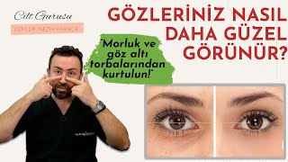 Solution of Eye Contour Problems: Under-eye bruises, Wrinkles, Puffing and Falling Eyebrows