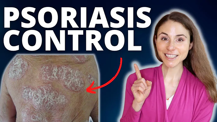 TOP 5 TIPS TO CONTROL PSORIASIS FLARES 😊 DERMATOLOGIST @DrDrayzday - DayDayNews