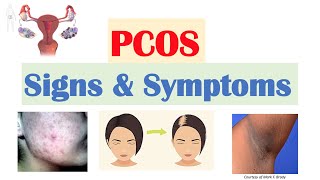 Polycystic Ovary Syndrome (PCOS) Signs & Symptoms | & Why They Occur