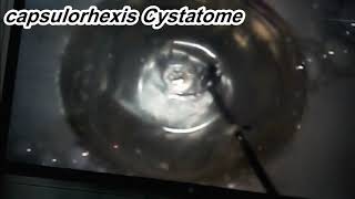 learning capsulorhexis in training eye cheap and effective learning capsulorhexis in training eye cheap and effective