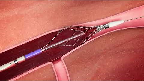 See how the Pounce™ Venous Thrombectomy System works