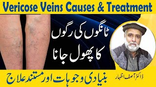 How To Treat Varicose Veins Naturally In Urdu