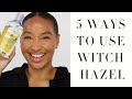 5 Ways to Use Witch Hazel | Witch Hazel Skincare + Acne Benefits