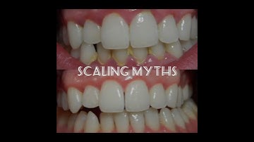 scaling(teeth cleaning)Myths#shortvideo #dentalcare