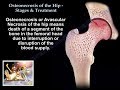 Osteonecrosis Of The Hip Stages & Treatment - Everything You Need To Know - Dr. Nabil