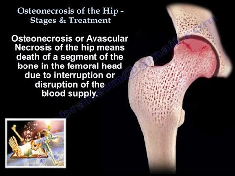 Video: Aseptic Necrosis - Stages, Aseptic Necrosis Of Bone, Femoral Head, Hip And Knee Joints, Humerus And Talus