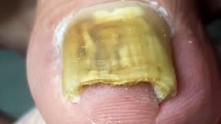 Amazing Two Toenails, Trim Ingrown Toenails~【Crazy pedicure room】
