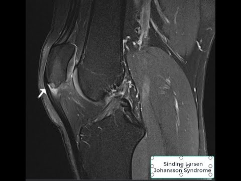Sinding Larsen Johansson Syndrome - YouTube