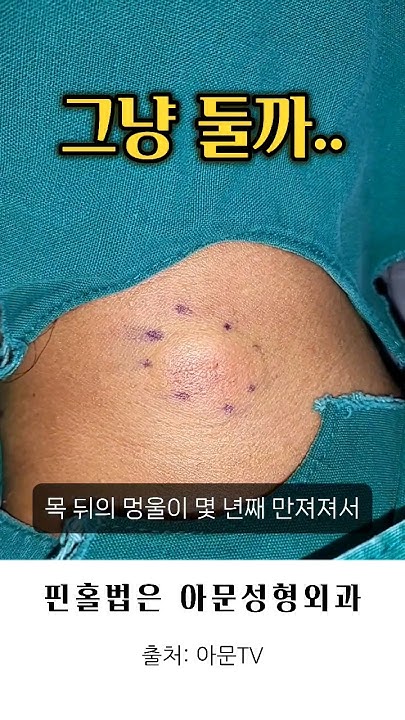 멍울 그냥 둬야 되나? (목 핀홀법 피지낭종 표피낭종 수술 켈로이드 피부과 성형외과 병원 Steatocystoma Surgery ...