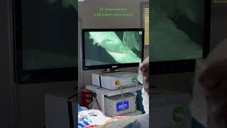 Using SPY System and Laser Angiography to show life within our Reverse Sural Artery Pedicle Flap π§ͺ