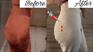 Großer Po Ohne Sport Und Op - Q&A