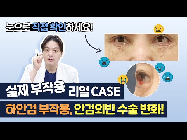 하안검 부작용, 안검외반 실제 부작용 리얼케이스로 알아보는 안검외반 증상과 수술방법