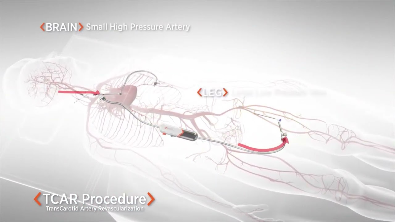 TCAR   TransCarotid Artery Revascularization Procedure Animation   Silk Road Medical   90sec