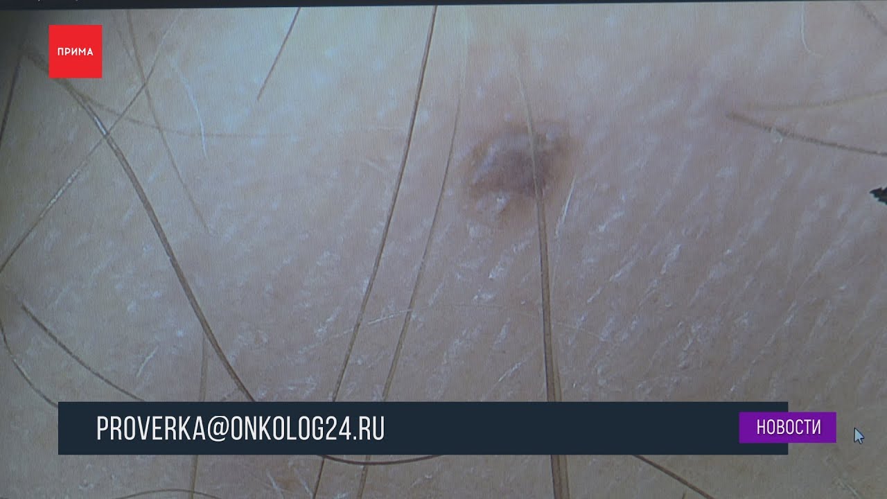 Проверить родинки можно будет онлайн