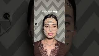 save for later - your acne map🗺️#acnecauses #acnetreatment #acne #koreanskincare #pimple #skincare