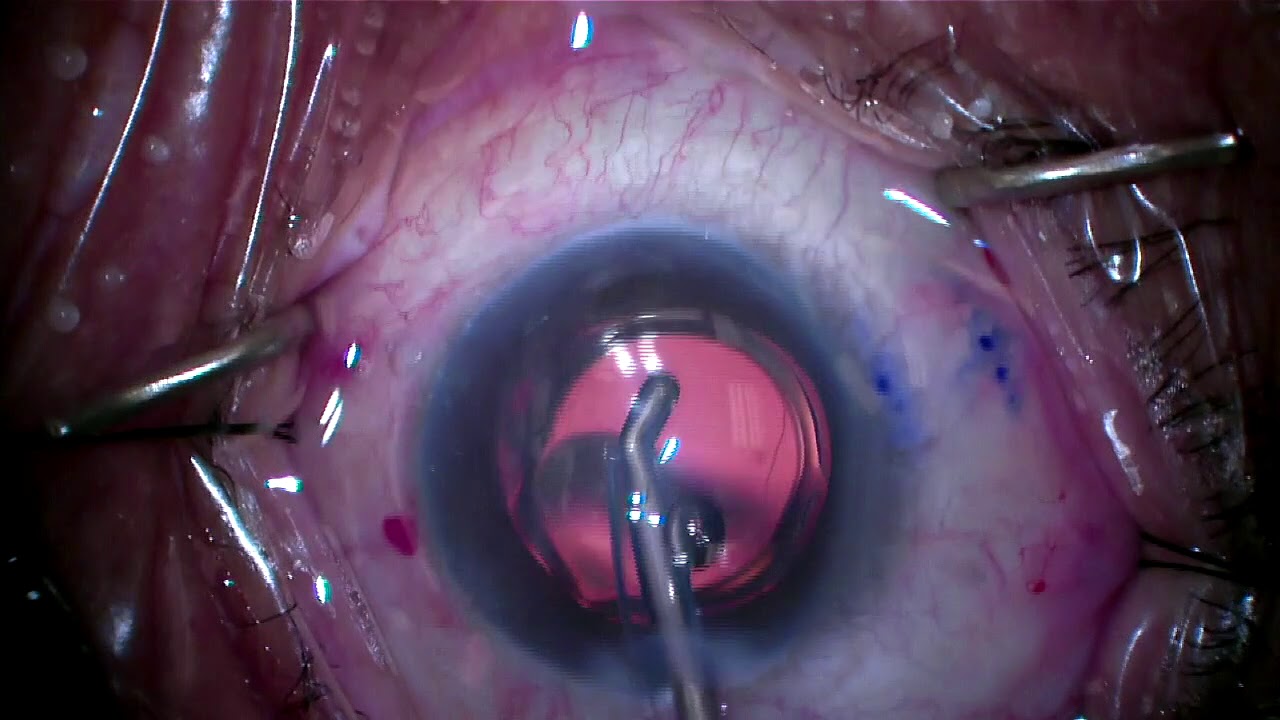 Glaucoma Xen Gel Stent - Ab Interno Technique - Paul Singh, MD