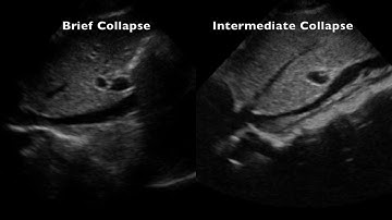 IVC: Brief Collapse Vs. Intermediate Collapse