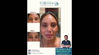 Squint Eye Strabismus Treatment Explained by Dr Ankit Shah Don’t Believe These Myths #drankitshah