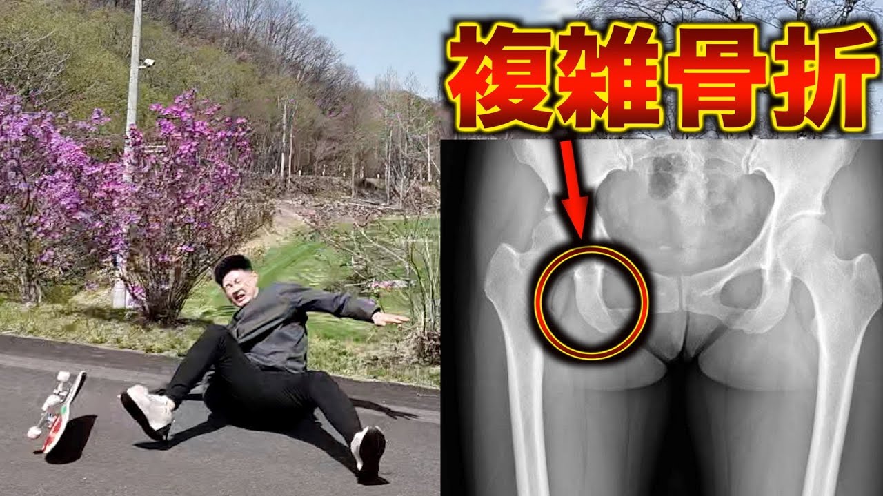 スケボーで転んでお尻の骨が折れました